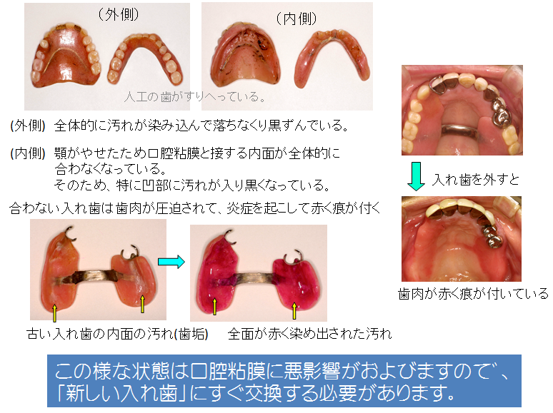 入れ歯が古くなるとこうなる