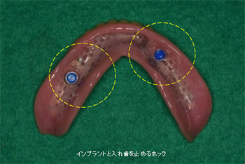 入れ歯の裏側