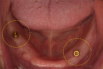 下顎骨に埋入されたインプラント体