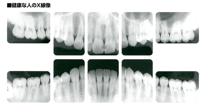 健康的な歯槽骨を示すレントゲン写真