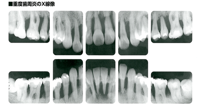 病的な歯槽骨を示すレントゲン写真