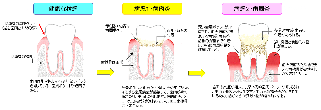 歯周病治療 歯科医はライフサポーター 酒田に2つの歯医者さん 五十嵐歯科医院