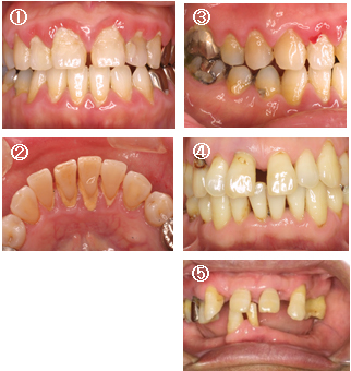 歯 周 病 治療